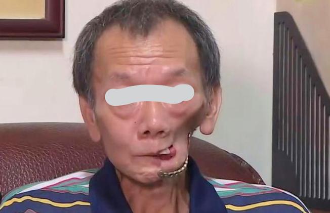 嚼槟榔20年患口腔癌,嚼槟榔20年患口腔癌几率大吗